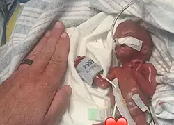 Nació a las 21 semanas y venció todo pronóstico: el bebé más prematuro del mundo celebra su primer cumpleaños
