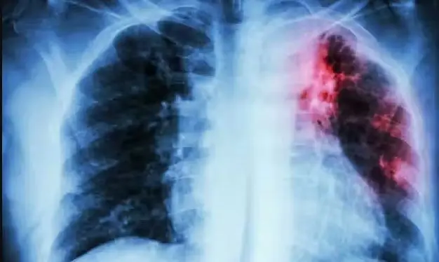 Perú impulsa el uso de una herramienta tecnológica para el tratamiento de la tuberculosis