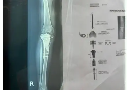 Aumentan tumores a nivel óseo en pacientes luego del COVID-19, afirman especialistas