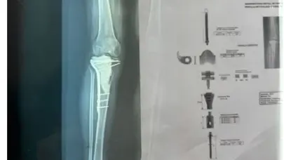 Aumentan tumores a nivel óseo en pacientes luego del COVID-19, afirman especialistas